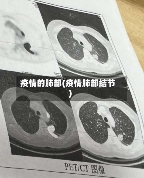 疫情的肺部(疫情肺部结节)-第2张图片