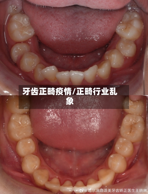 牙齿正畸疫情/正畸行业乱象