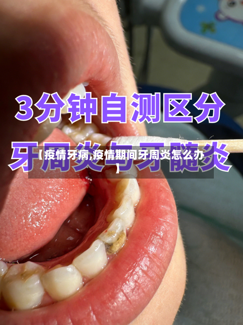 【疫情牙病,疫情期间牙周炎怎么办】