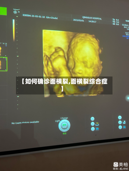 【如何确诊面横裂,面横裂综合症】-第2张图片