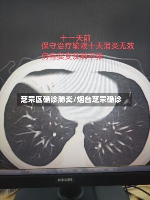 芝罘区确诊肺炎/烟台芝罘确诊