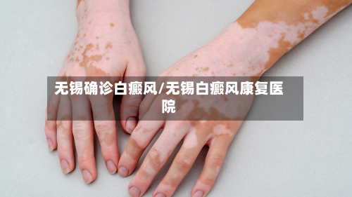 无锡确诊白癜风/无锡白癜风康复医院